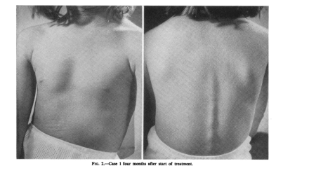 Wink_guérison ichtyose_après