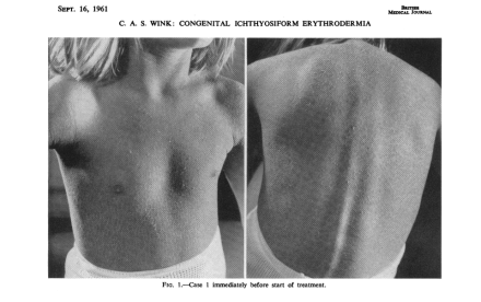 Wink_guérison ichtyose_avant